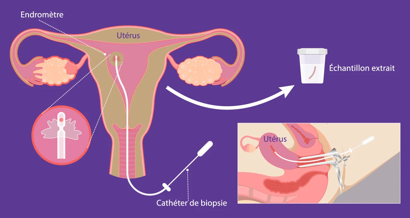 Biopsie de l’endomètre réalisée au centre IRIFIV Casablanca pour analyser la muqueuse utérine dans le cadre du bilan de fertilité féminine