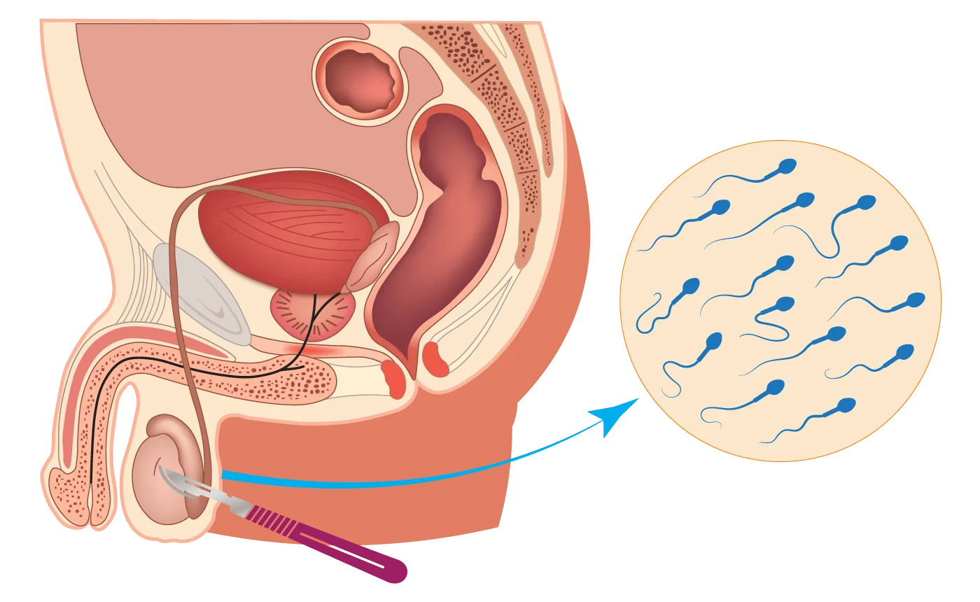 Schéma de la biopsie testiculaire et de la récupération des spermatozoïdes développé par IRIFIV Casablanca