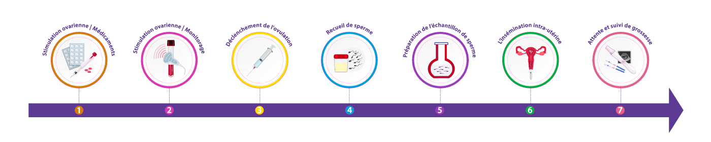 Schéma des différentes étapes de la procédure d’insémination intra-utérine (IUI) pour favoriser la conception