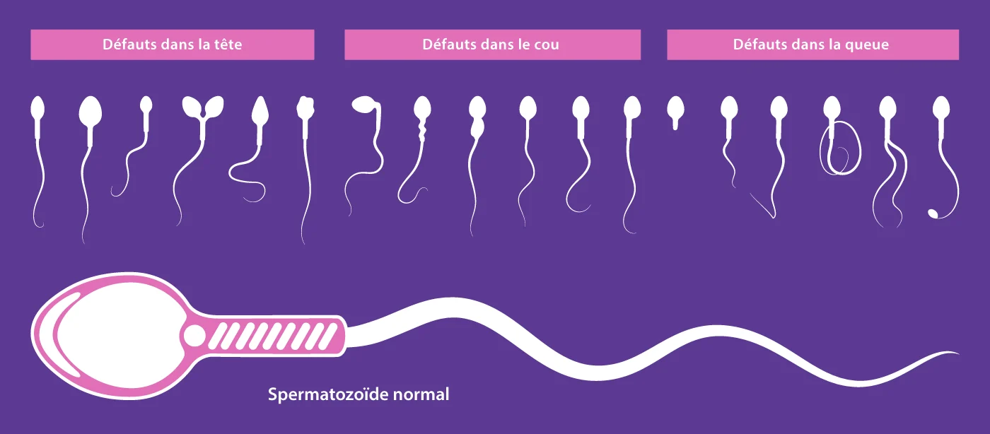 Schéma de l'évaluation de la morphologie des spermatozoïdes développé par IRIFIV Casablanca