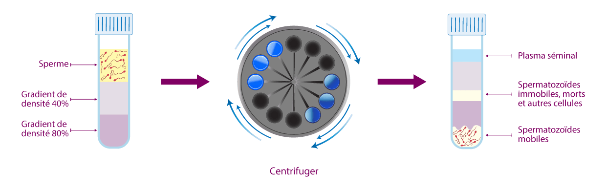 Technique du gradient de densité pour la sélection des spermatozoïdes viables au centre IRIFIV Casablanca