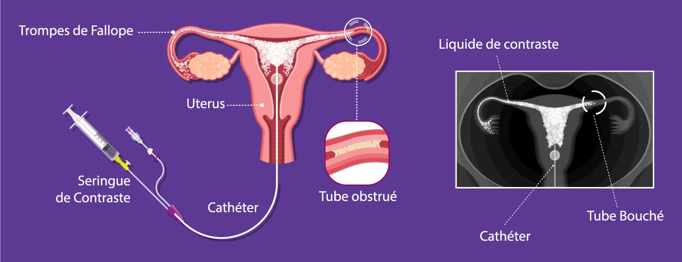Hystérosalpingographie effectuée au centre IRIFIV Casablanca pour vérifier la perméabilité des trompes de Fallope et la cavité utérine