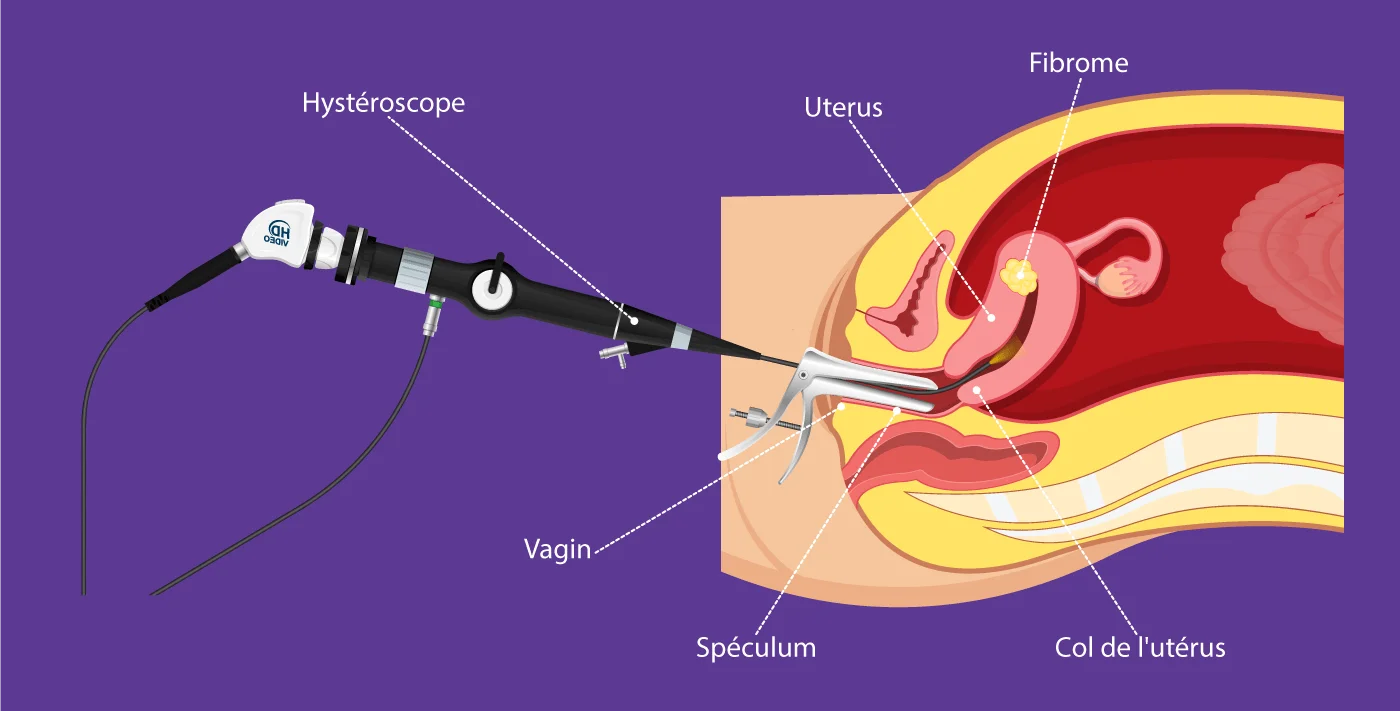 Hystéroscopie diagnostique au centre IRIFIV Casablanca pour examiner la cavité utérine et détecter d’éventuelles anomalies