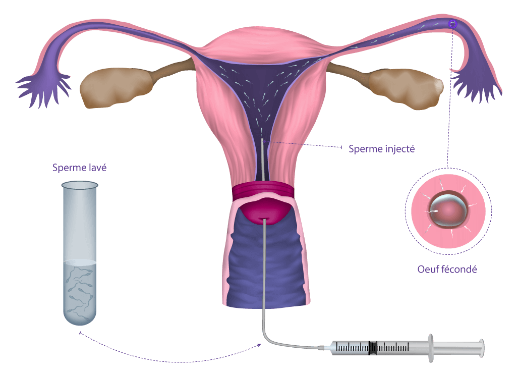 Illustration de la procédure d’insémination intra-utérine (IIU) réalisée au centre IRIFIV Casablanca