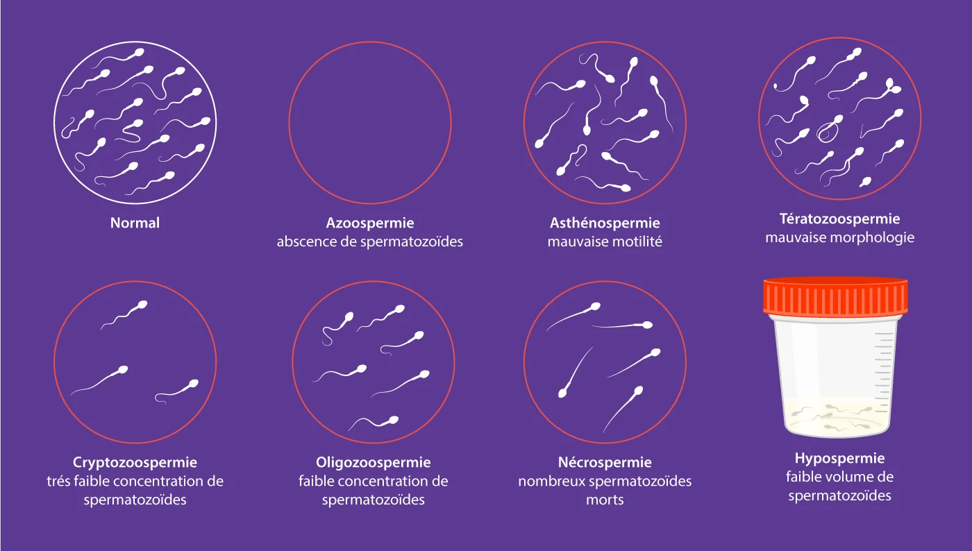 Schéma du spermogramme et des anomalies séminales développé par IRIFIV Casablanca