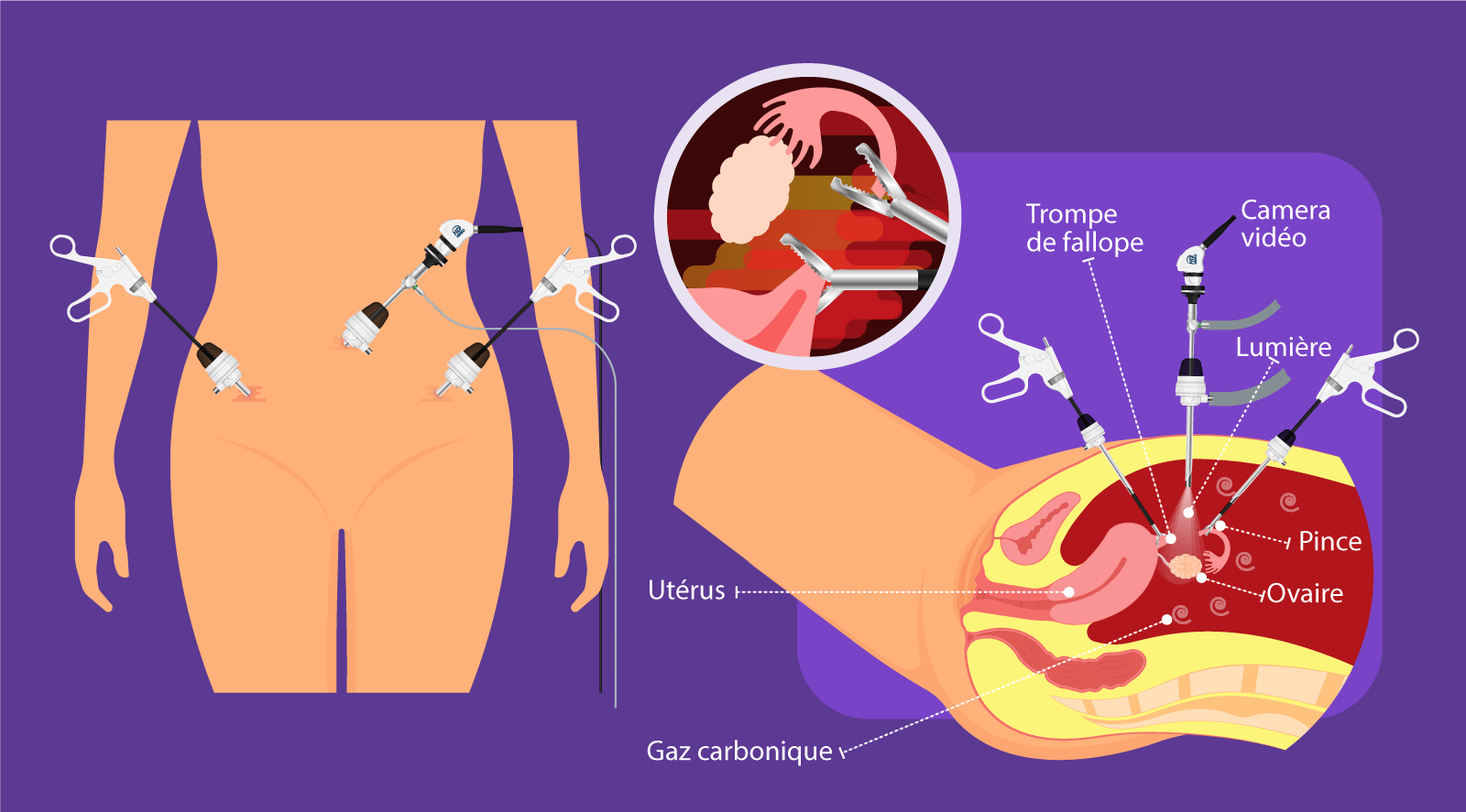 Illustration de la salpingectomie laparoscopique – chirurgie mini-invasive des trompes de Fallope