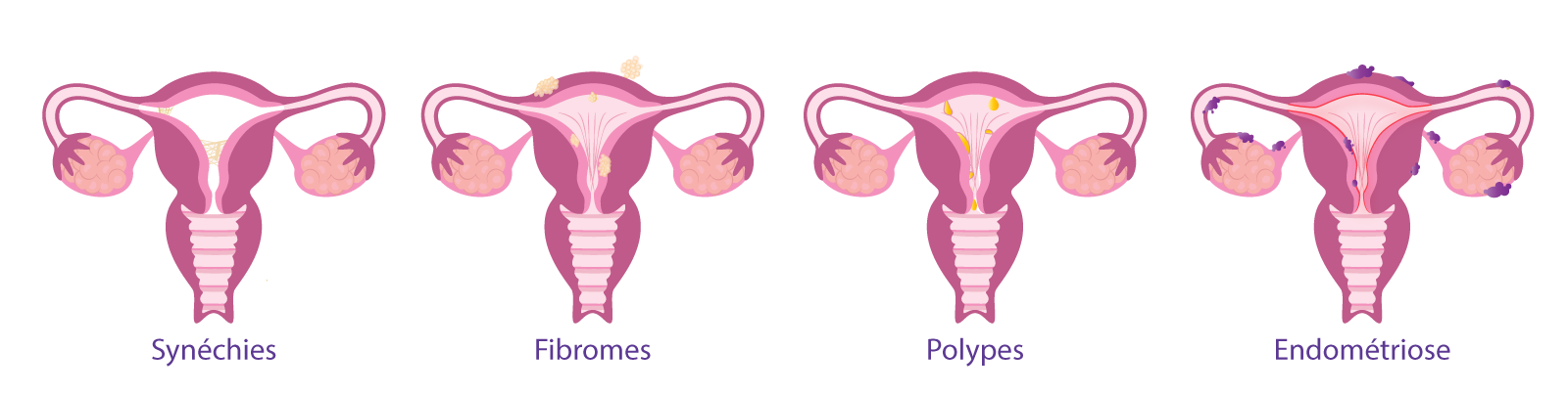 Illustration des anomalies utérines pouvant empêcher une grossesse, diagnostiquées et traitées au centre IRIFIV Casablanca