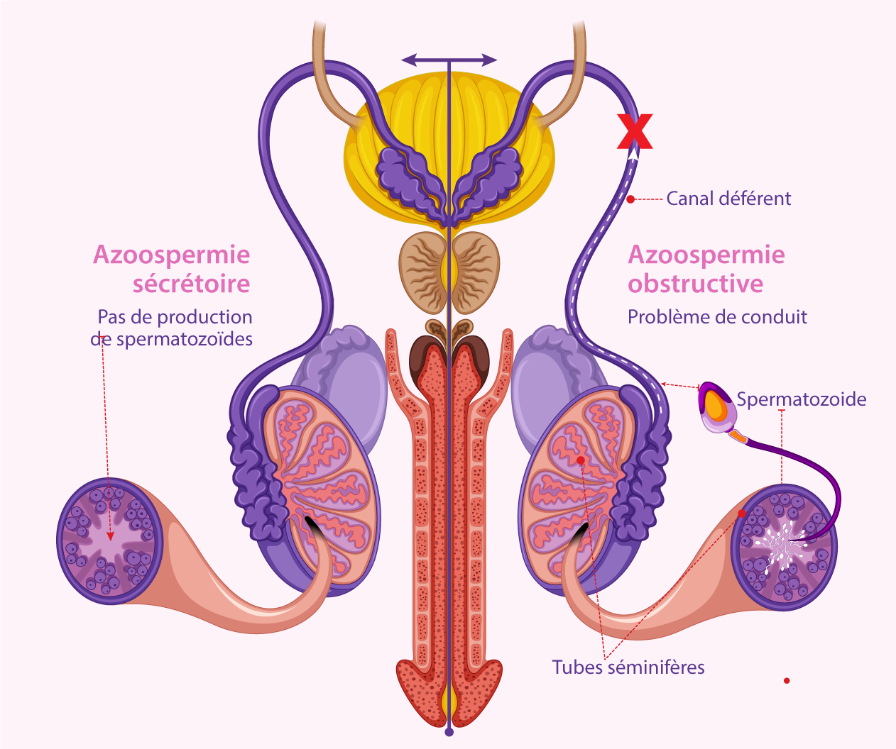 Azoospermie – Infertilité masculine – IRIFIV Casablanca L’azoospermie – Absence de spermatozoïdes dans le sperme – IRIFIV Casablanca