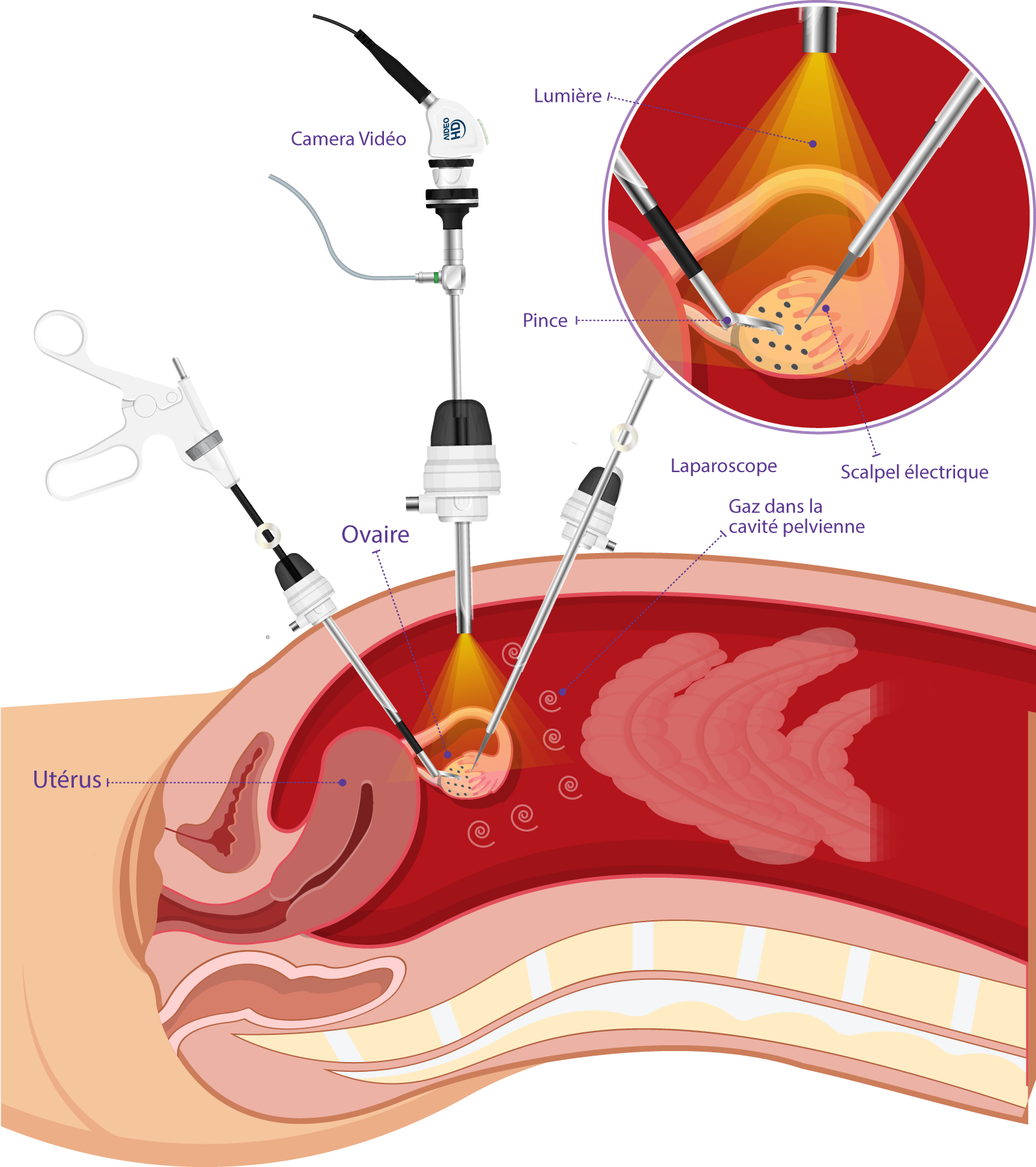 Drilling ovarien par coelioscopie – procédure et efficacité Drilling ovarien par voie laparoscopique pour restaurer l’ovulation