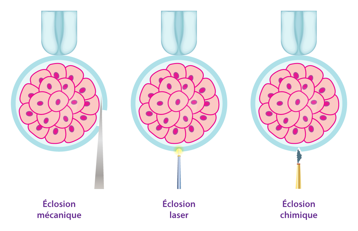 Éclosion assistée : techniques laser, chimique et mécanique Les trois techniques d’éclosion assistée (laser, chimique, mécanique) en FIV – IRIFIV Casablanca