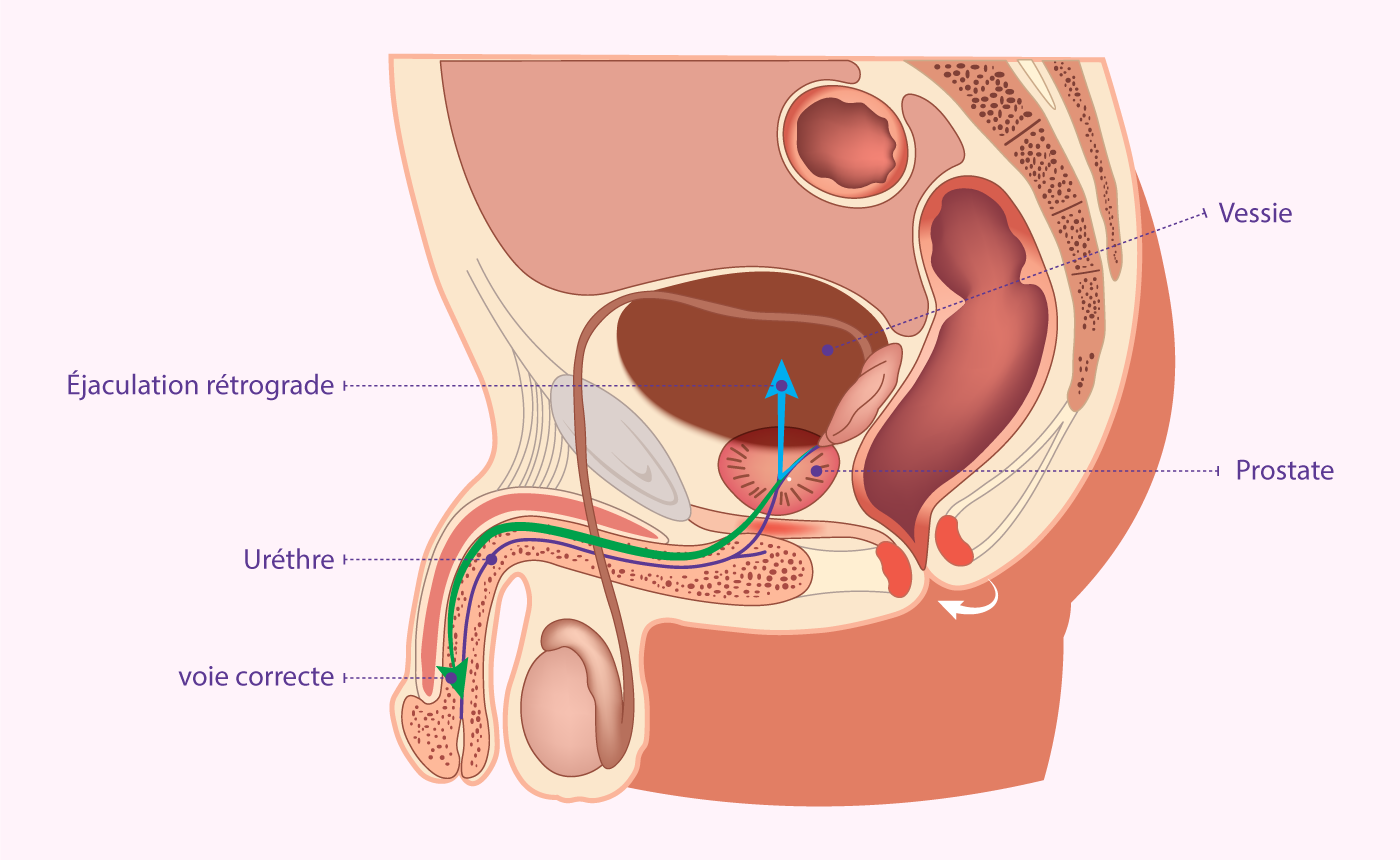 Illustration de l’éjaculation rétrograde – cause d’infertilité masculine