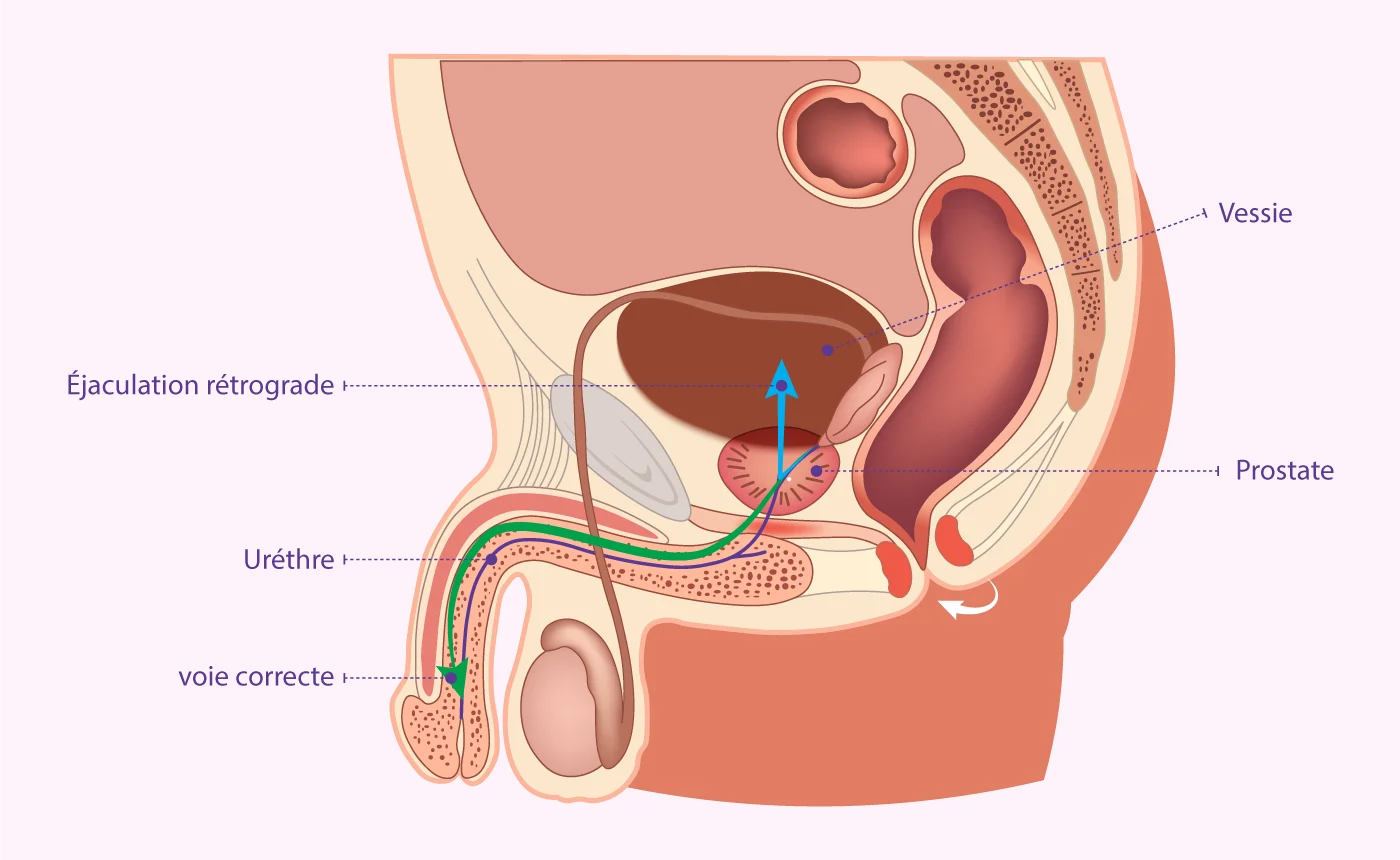 Schéma de l'éjaculation rétrograde développé par IRIFIV Casablanca