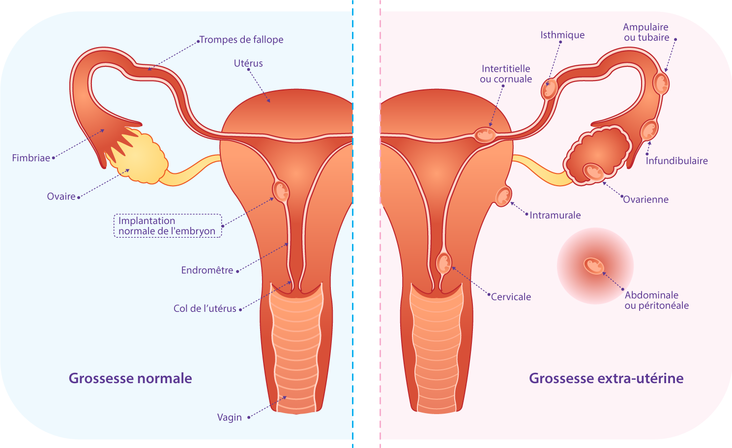 Image illustrant la grossesse extra-utérine (ectopique) traitée par les spécialistes en fertilité du centre IRIFIV Casablanca