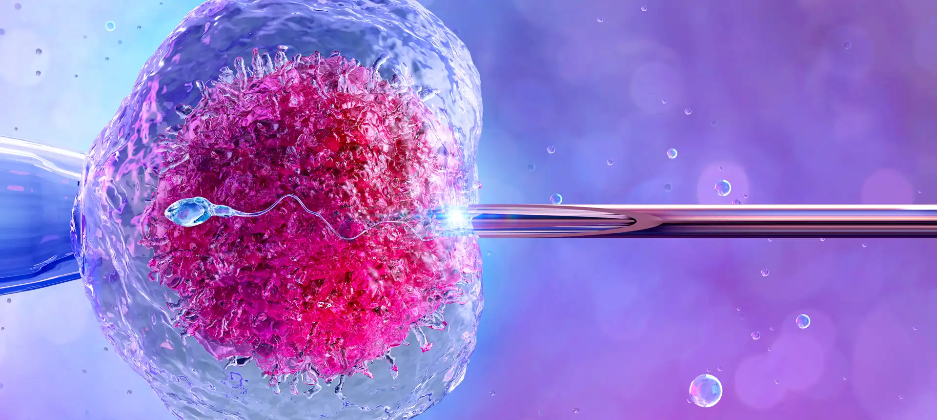 ICSI IRIFIV Casablanca – Micro-injection de spermatozoïdes pour la FIV