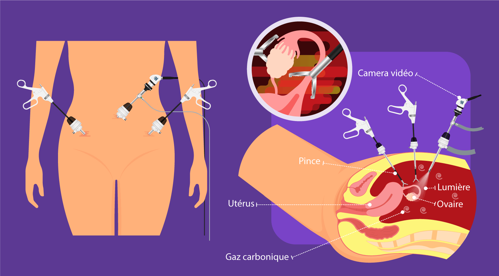 Illustration de la procédure de laparoscopie à la Clinique IRIFIV Casablanca