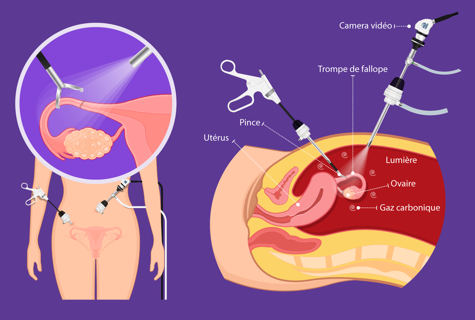 Illustration de la reperméabilisation tubaire – chirurgie de la fertilité