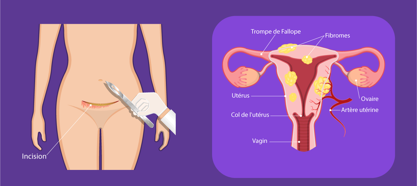 Illustration de la myomectomie abdominale pour le traitement des fibromes utérins