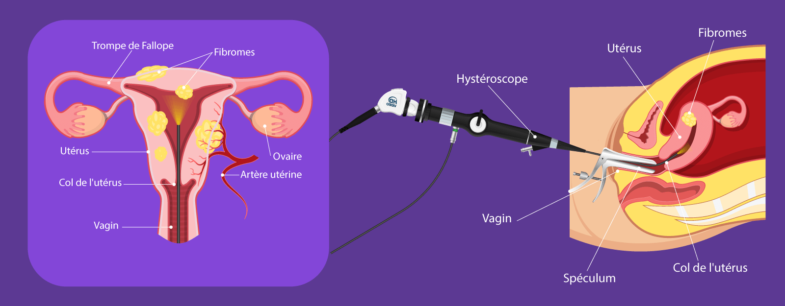 Illustration de la myomectomie hystéroscopique – ablation des fibromes par voie naturelle