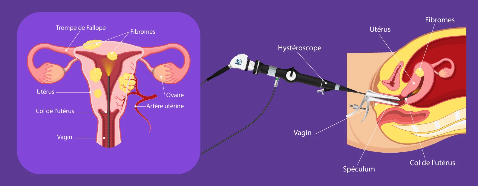 Schéma de la myomectomie hystéroscopique développé par IRIFIV Casablanca