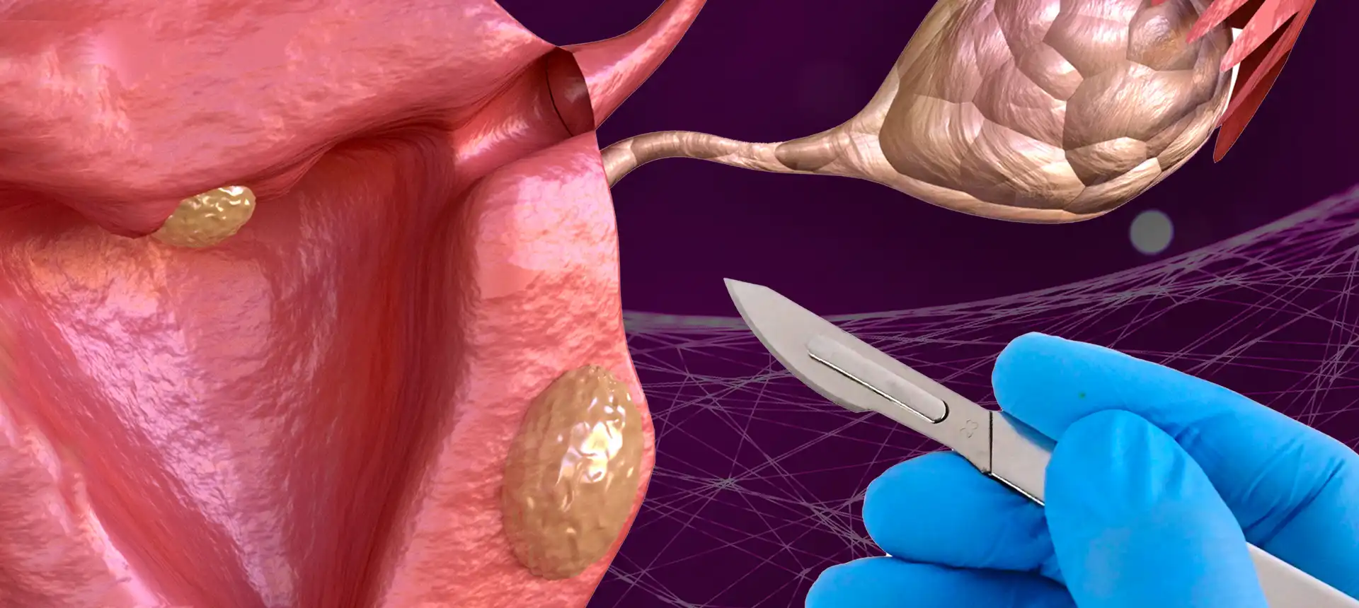 Myomectomie – IRIFIV Casablanca Myomectomie chez IRIFIV Casablanca