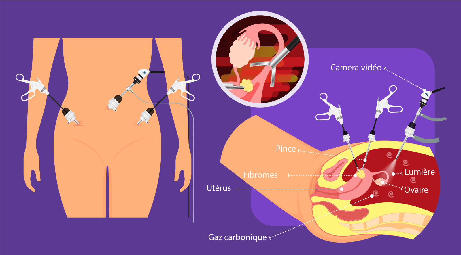 Illustration de la myomectomie laparoscopique – chirurgie mini-invasive pour retirer les fibromes