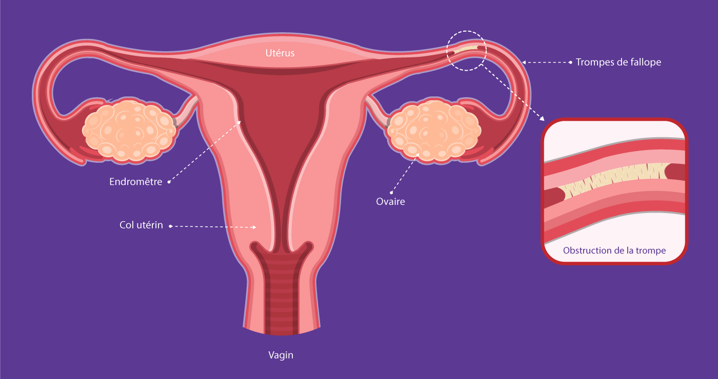 Schéma explicatif de l’obstruction des trompes de Fallope, cause fréquente d’infertilité féminine traitée au centre IRIFIV Casablanca