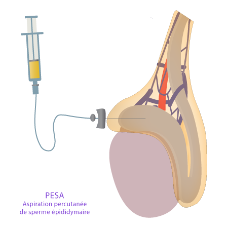 PESA – Technique de récupération de spermatozoïdes – IRIFIV Casablanca PESA – Aspiration percutanée de sperme épididymaire réalisée à l’IRIFIV Casablanca
