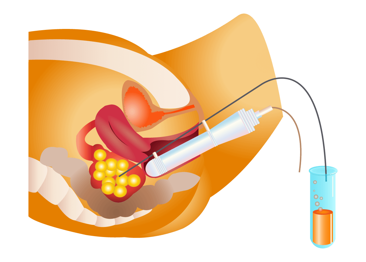Image illustrant la ponction ovocytaire réalisée avant la vitrification au centre IRIFIV Casablanca
