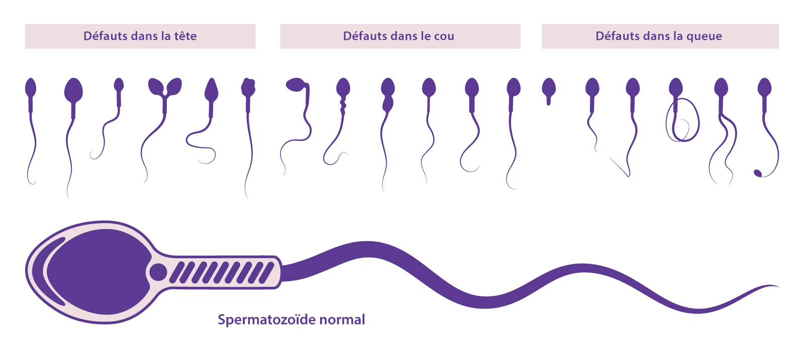 Schéma de la préparation et de la sélection des spermatozoïdes pour une ICSI développé par IRIFIV Casablanca
