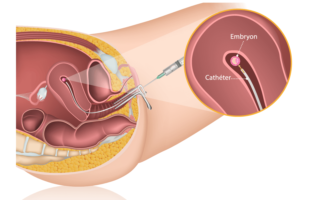 Procédure de transfert d’embryons au centre IRIFIV Casablanca avec suivi échographique