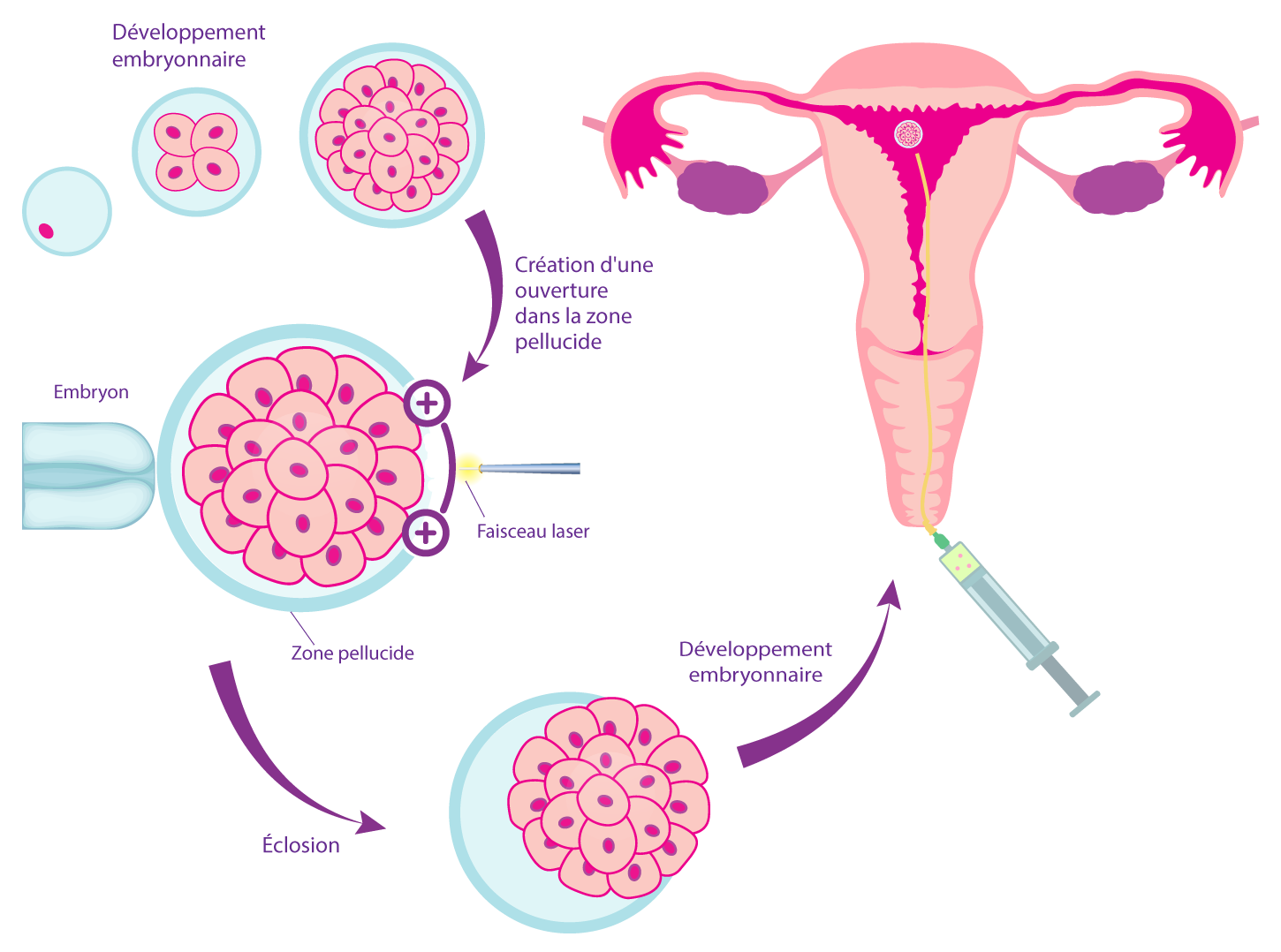 Processus de l’éclosion assistée Processus de l’éclosion assistée en FIV – IRIFIV Casablanca
