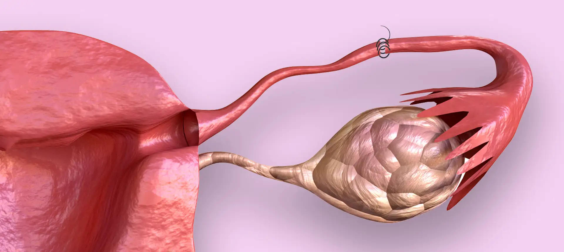 Reperméabilisation tubaire – IRIFIV Casablanca Reperméabilisation tubaire à IRIFIV Casablanca