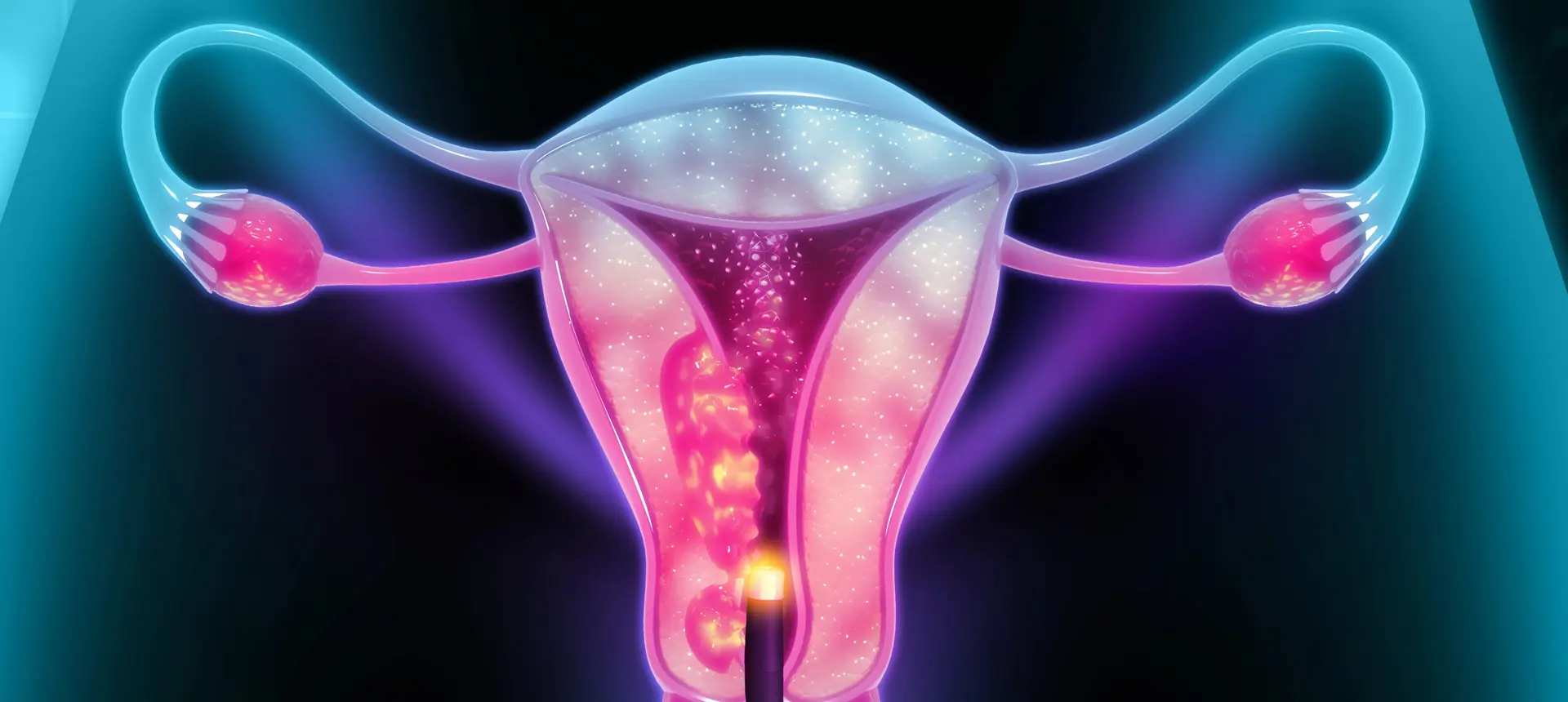 Scratching endométrial – amélioration de la réceptivité utérine avant FIV au centre IRIFIV Casablanca