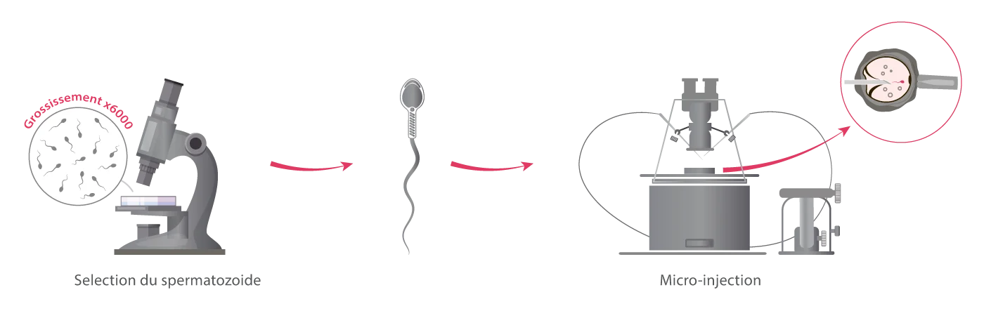 Schéma de la technique IMSI avec sélection des spermatozoïdes à fort grossissement développé par IRIFIV Casablanca