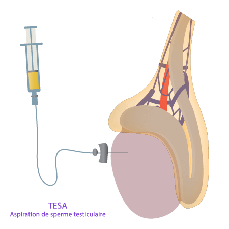 TESA – Aspiration de sperme testiculaire – IRIFIV Casablanca TESA – Aspiration testiculaire de spermatozoïdes effectuée à l’IRIFIV Casablanca