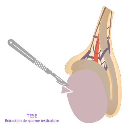 TESE – Biopsie testiculaire pour azoospermie – IRIFIV Casablanca Biopsie testiculaire TESE – Récupération de spermatozoïdes au centre IRIFIV Casablanca