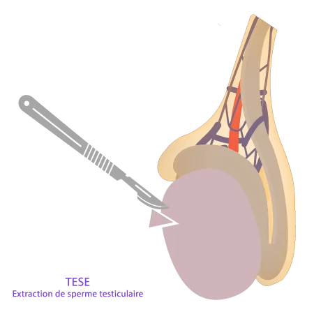Schéma de la technique TESE (biopsie testiculaire) développé par IRIFIV Casablanca